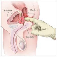 Avatar de Prostate